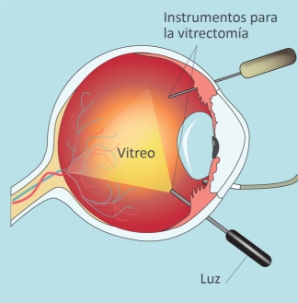 Retina-Desprendimiento-Vitrectomia-01