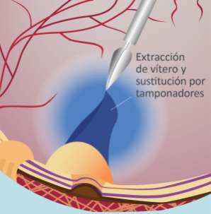 Retina-Desprendimiento-Vitrectomia-02