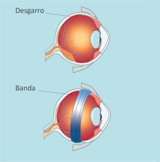 Retina-Desprendimiento-Cirugia-Escleral-paso-01