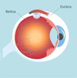 Retina-Desprendimiento-Cirugia-Escleral-paso-02-1