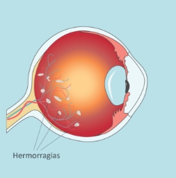 Retina-Retinopatia-QueEs-02