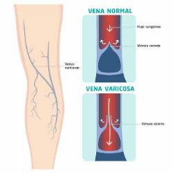 VENA VARICOSAS INFOGRAFIA_page-0001 (1)