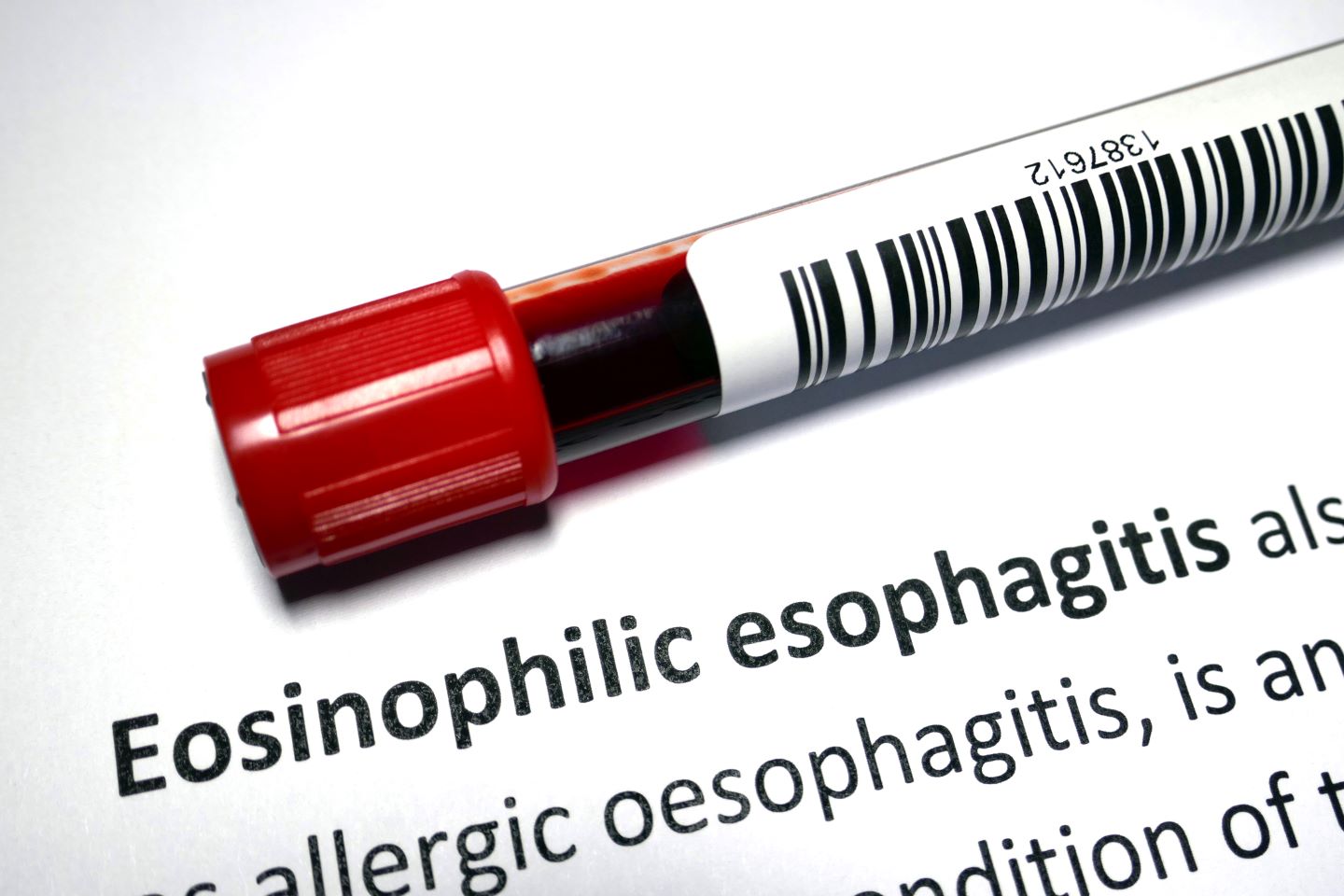 Esofaguitis