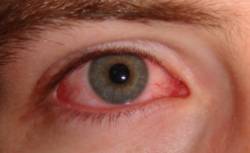 lagrimas artificiales hidratacion ocular conjuntivitis