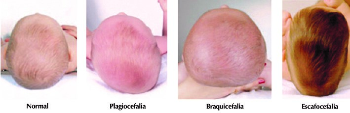 Cojin plagiocefalia para evitar deformidades craneales - El Recien