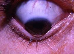 Hablemos del queratocono Blogs Quir nsalud