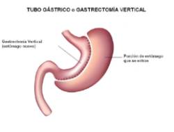 tubo gástrico