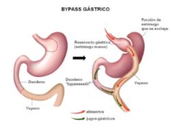 bypass gástrico