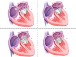 Infografía implante percutáneo de válvula mitral