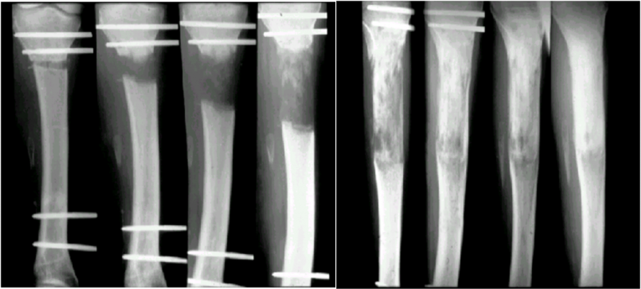 Alargamiento-de-tibia-en-agenesia-de-peroné-1024x462