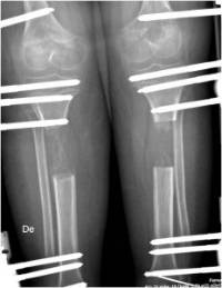 talla-baja-tibia-232x300