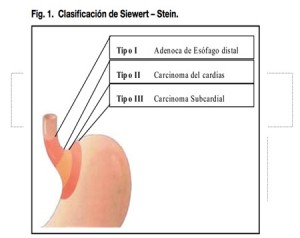 Cáncer gástrico esofágico