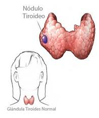 Nódulo