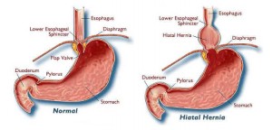 Hernia _1