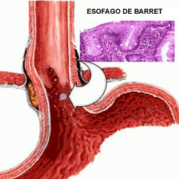 Hernia_4