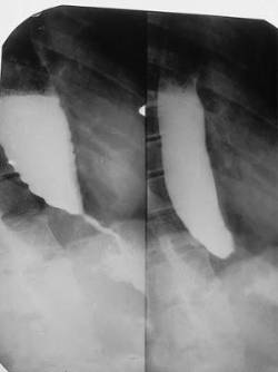 Acalasia