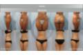 LIPOSUPCIÓN_MUSLOS_ANTESYDESPUES