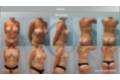 mastopexia_antesydespues