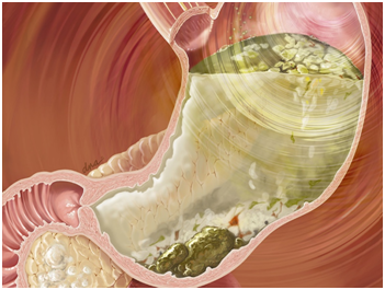 gastroparesia - GPOEM