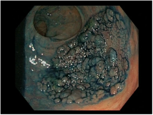 diseccion endoscópica submucosa1