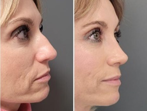 antes y después de rinoplastia orl vozmediano