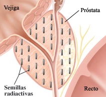 vejiga-semillas-radiactivas