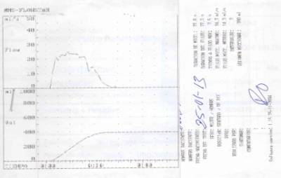 Fig1-Registro-en-papel-de-una-flujometria-con-curvas-de-miccion-normal