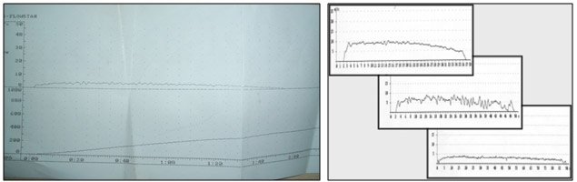 Fig2-Registro-en-papel-de-una-flujometria-con-una-curva-de-miccion-compatible-con-estenosis-de-uretra