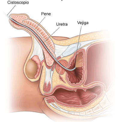 Fig4-Partes-de-la-anatomia-que-evalua-una-citoscopia-en-el-hombre