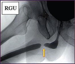 Fig7-Imagen-de-uretrografia-retrograbada-y-miccional