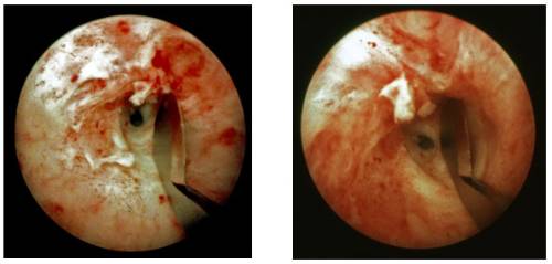 Figura-5.-Accion-de-corte-del-cuchillete-endoscopico