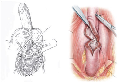 Fig10.-Incision-por-perine-y-abordaje-de-la-estenosis-extirpando