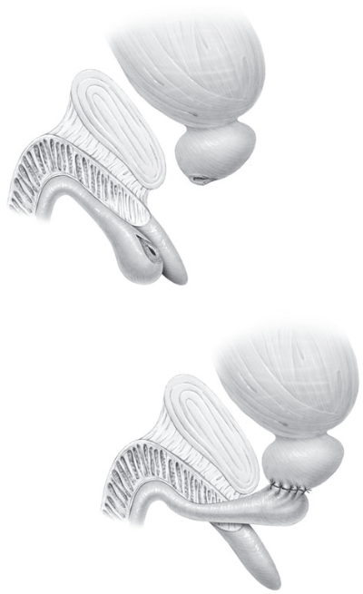 Fig1-separacion-de-uretra-por-causa-traumatica-y-anastomosis