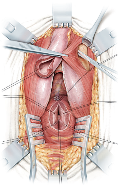 FigD-Movilizacion-de-uretra-bulbar-y-exposicion-del-pubis