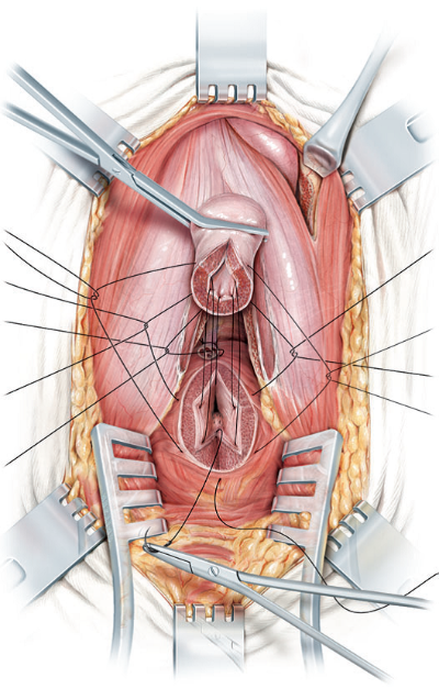 FigE-Anastomosis-de-ambos-extremos-en-zona-sana