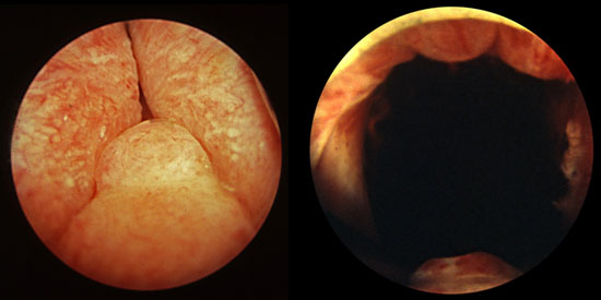 rtu-antes-despues-endoscopia 5