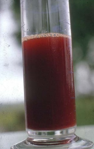 fig4-hematuria-franca-o-sangre-en-la-orina