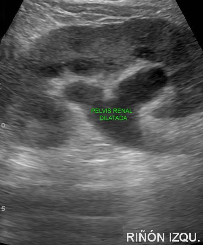 fig6-pelvis-renal-dilatada-por-causa-obstructiva