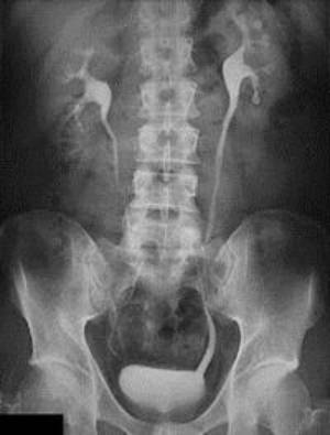 fig7-Urografia-intravenosa