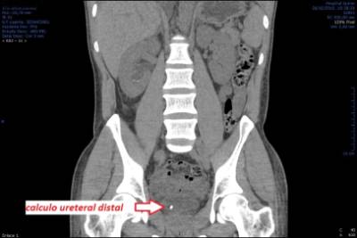fig8-UroTAC-litiasis-uretral-distal-dcha