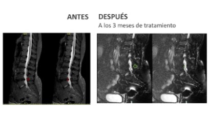 ANTES Y DESPUÉS DISCOLOSIS CON OZONO HERNIA DISCAL