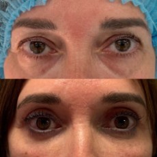Resultado de la blefaroplastia sin cirugía 1