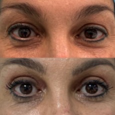Resultado de la blefaroplastia sin cirugía 2