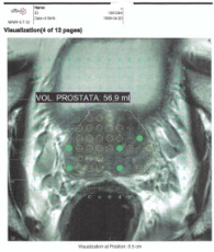 imagen_biopsia_por_fusión