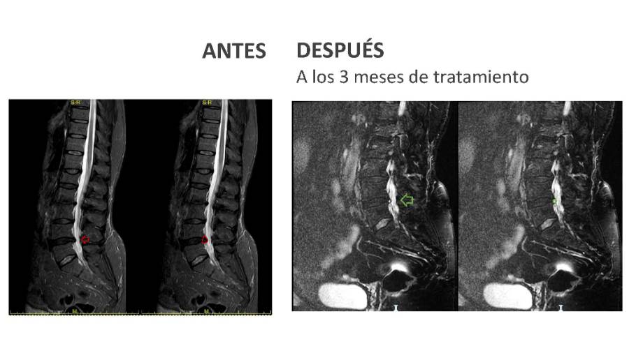 ANTES Y DESPUÉS DISCOLOSIS CON OZONO HERNIA DISCAL