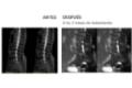 ANTES Y DESPUÉS DISCOLOSIS CON OZONO HERNIA DISCAL