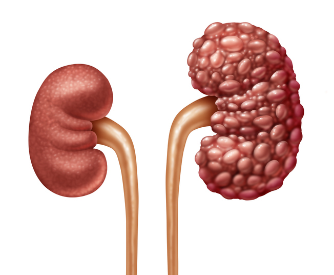 enfermedad renal