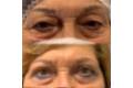 Resultado de la blefaroplastia sin cirugía ppal