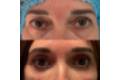 Resultado de la blefaroplastia sin cirugía 1