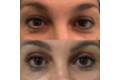 Resultado de la blefaroplastia sin cirugía 2